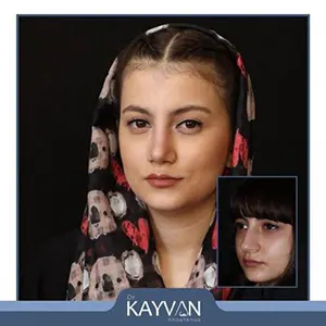 نمونه جراحی بینی
