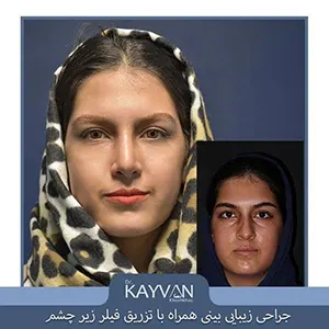 نمونه جراحی بینی