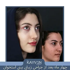 نمونه جراحی بینی استخوانی