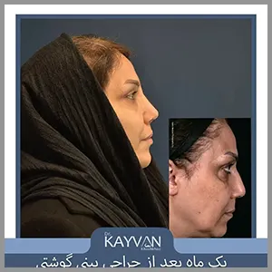 بینی-گوشتی-عمل-1