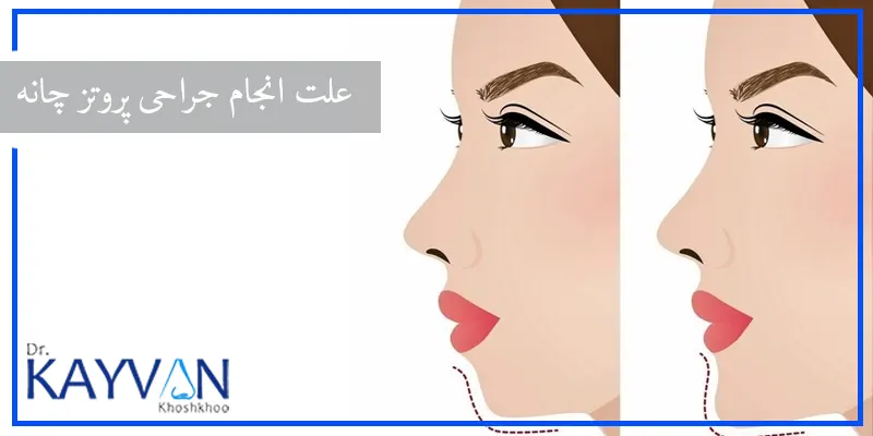استفاده از جراحی پروتز چانه برای زیباسازی و تناسب میان اجزای صورت ارجحیت بالاتری نسبت به تزریق دارد، چرا که برای انجام این جراحی از پروتزهای جامد و سازگار با بدن استفاده می شود؛ و همین امر منجر به کم ترین میزان واکنش بدن به این پروتزها خواهد شد.