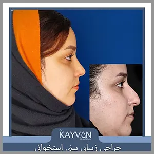 Alt Text سه ماه بعد از جراحی زیبایی بینی متناسب با فرم صورت و نظر و سلیقه زیباجو