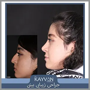 Alt Text جراحی زیبایی بینی با نوک گوشتی و پوست ضخیم و قوز استخوانی که تمامی نواقص رفع شده و نتیجه بسیار عالی رو در برداشته