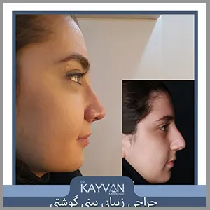 جراحی زیبایی بینی گوشتی متناسب با فرم صورت و نظر و سلیقه زیباجو..