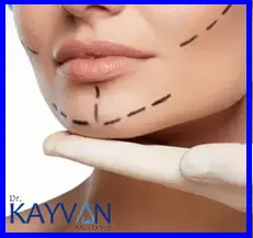 بیمار با توجه به شرایطش ابتدا تحت بی حسی موضعی یا بیهوشی عمومی قرار گرفته سپس برش هایی در دهان یا زیر چانه افراد توسط جراح ایجاد خواهد شد. برش داخل دهانی از طریق لب پایینی در تماس با لثه ایجاد شده و برش زیر چانه در ناحیه دو یا سه سانتی چین زیر چانه ایجاد خواهد شد؛ و در نهایت پروتزها در داخل برش ایجاد شده جای گذاری خواهند شد و برش ها بخیه زده می شوند.