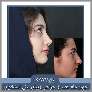 چهار ماه بعد از عمل زیبایی بینی استخوانی بینی طبیعی با قوس ملایم و رفع افتادگی نوک بینی 🔺تقویت غضروف های درونی 🔺رفع افتادگی نوک بینی 🔺اصلاح قوز بینی