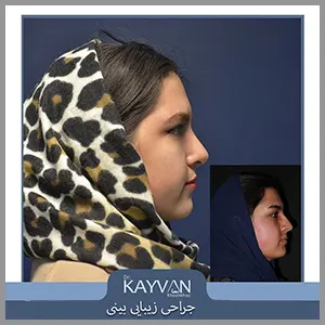 نمونه-کار-جراحی-بینی-طبیعی-دکتر-خوشخو
