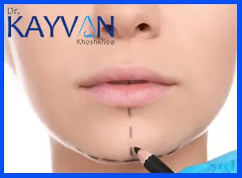 افراد دارای چانه عقب رفته
افراد دارای چانه نوک تیز یا مربعی شکل
افراد دارای چانه های کوچک
افراد دارای غبغب بزرگ و گردن چاق
افراد دارای بینی برجسته