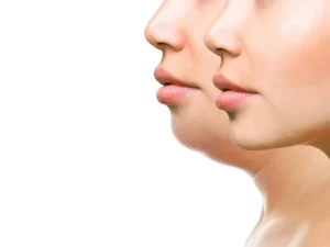 جراحی پروتز چانه