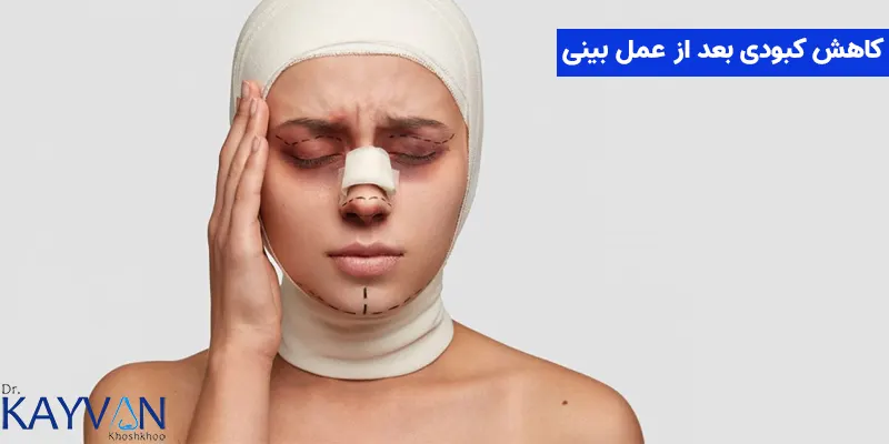 مصرف آبمیوه های طبیعی مانند آب کرفس، آب هویج و آب آناناس 

پیاده روی به آهستگی 

استفاده از کمپرس یخ به مدت 48 تا 72 ساعت بعد از عمل در اطراف چشم ها 

خودداری از دست زدن به پانسمان بینی 

خودداری از قرار گرفتن در معرض نور مستقیم خورشید برای جلوگیری از افزایش کبودی و ایجاد لکه بر روی بینی و چشم ها 

پرهیز از مصرف مشروبات الکلی و دخانیات به مدت دو هفته بعد از عمل برای کاهش کبودی و افزایش سرعت روند بهبودی 

پرهیز از مصرف داروهای رقیق کننده خون مانند آسپرین و پروفن به مدت دو هفته بعد از جراحی برای کاهش خونریزی و کبودی 

استفاده از کمپرس گرم پس از دو روز استفاده از کمپرس سرد برای افزایش جریان خون و کاهش کبودی