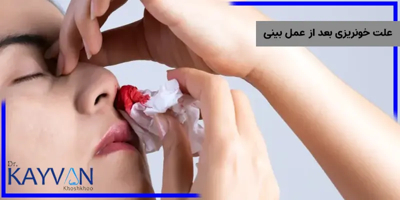 یکی از عوارض این جراحی خونریزی بینی می باشد، که دلایل مختلفی دارد از مهم ترین دلایل بروز خونریزی بعد از عمل بینی می توان به فشار خون بالا، مصرف داروهای رقیق کننده خون، تاثیر داروهای بیهوشی، استفاده از داروهای ضد انعقاد خون، انحراف شدید بینی و خشکی بینی بعد از عمل اشاره کرد. در ادامه به توضیح هر کدام از این موارد خواهیم پرداخت. 