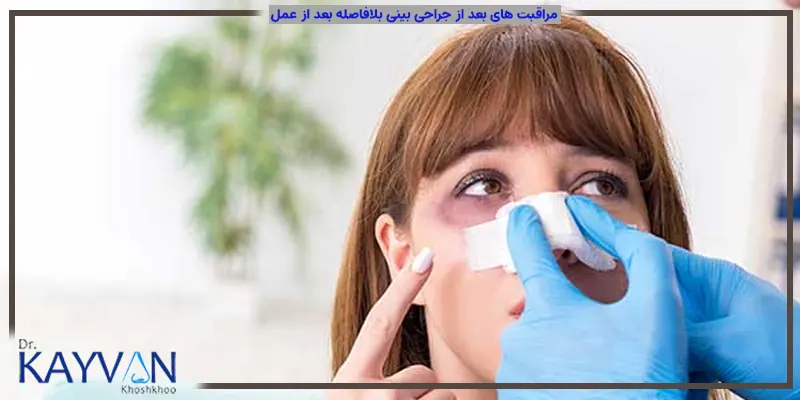 پس از عمل بهترین جراح بینی اسپلینتی داخل بینی برای محافظت از ساختار جدید بینی قرار خواهد داد. و تا جایی که ممکن باشد از پانسمان داخل بینی استفاده نخواهد شد