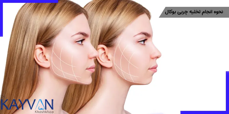 نحوه انجام تخلیه چربی بوکال