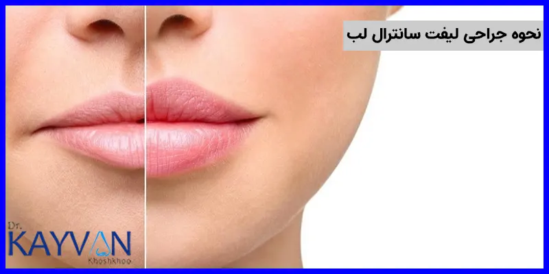 برای انجام این جراحی ابتدا فرد تحت بیهوشی عمومی قرار گرفته و سپس جراح میزان بلندی فاصله لب تا بینی را نشانه گذاری کرده و سپس آن را برش داده و جدا خواهد کرد و در نهایت محل برش بخیه زده خواهد شد. این جراحی سرپایی بوده و مدت زمان انجام آن در حدود 30 الی 60 دقیقه می باشد. برای انجام این جراحی تکنیک های مختلفی وجود دارد که در ادامه به بررسی آن ها خواهیم پرداخت. 