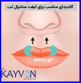 افراد دارای فاصله زیاد بین لب و بینی 

افراد بالای 18 سال 

افرادی که دندان های آن ها در هنگام لبخند زدن دیده نشده و همینطور فاصله بین لب و بین آن ها بیشتر از 1.5 سانتی متر باشد. 

افرادی که دارای لب های تخت، نازک و باریکی هستند. 

افرادی که متقاضی اعمال تغییرات و ایجاد برجستگی دائمی و ماندگار بر روی لب های خود هستند.
