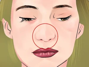 تورم و کبودی بعد از عمل بینی
