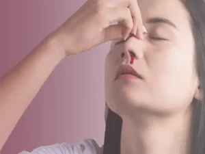 خونریزی بعد از عمل بینی