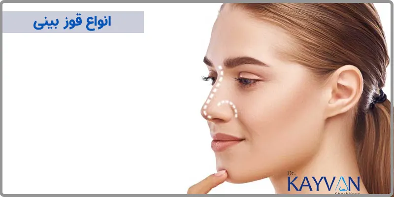 انواع-قوز-بینی