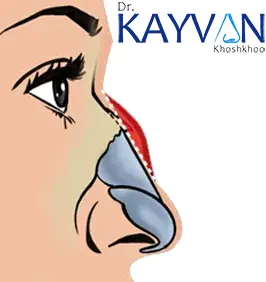 تشخیص-قوز-بینی