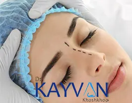 عمل ترمیم بینی برای رفع و از بین بردن ایرادات عمل بینی اولیه انجام خواهد شد و همینطور در صورتی که ایرداتی در عمل اولیه بینی رفع نشده باشد می توان با انجام این جراحی آن ها را برطرف کرد. 
