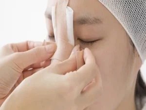 جراحی بینی شکسته
