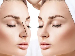 جراحی قوز بینی