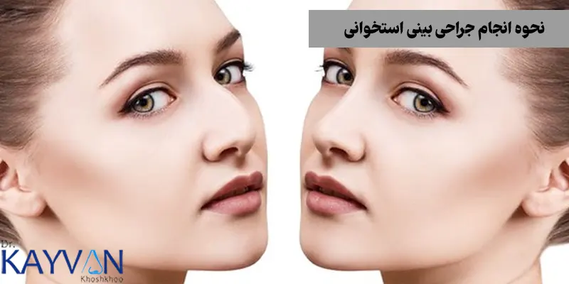 نحوه-انجام-جراحی-بینی-استخوانی