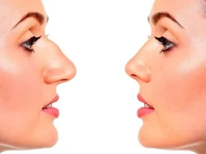 جراحی بینی استخوانی