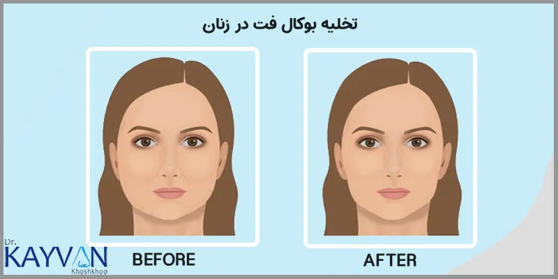 تخلیه-بوکال-فت-در-زنان