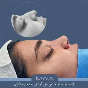 جراحی-بینی-گوشتی-نمونه-کار-1