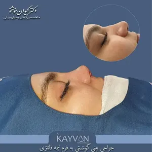 نمونه-کار-جراحی-بینی-گوشتی-دکتر-خوشخو