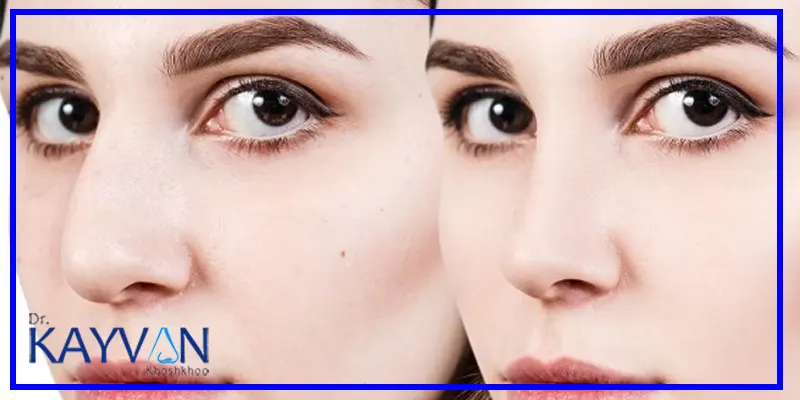 ویژگی-های-بهترین-جراح-بینی-گوشتی