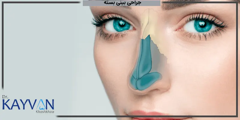 افراد-مناسب-جراحی-بینی-بسته