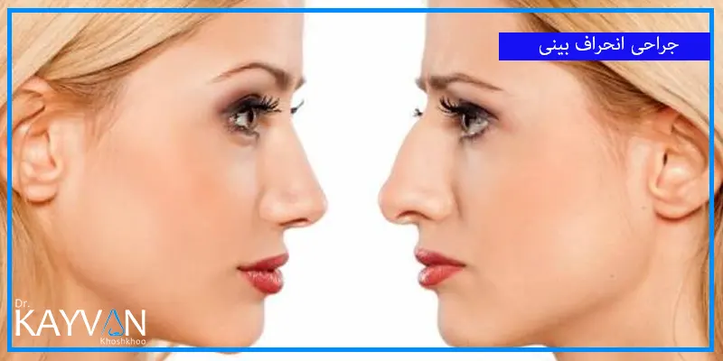 جراحی-انحراف-بینی-و-نحوه-انجام-آن