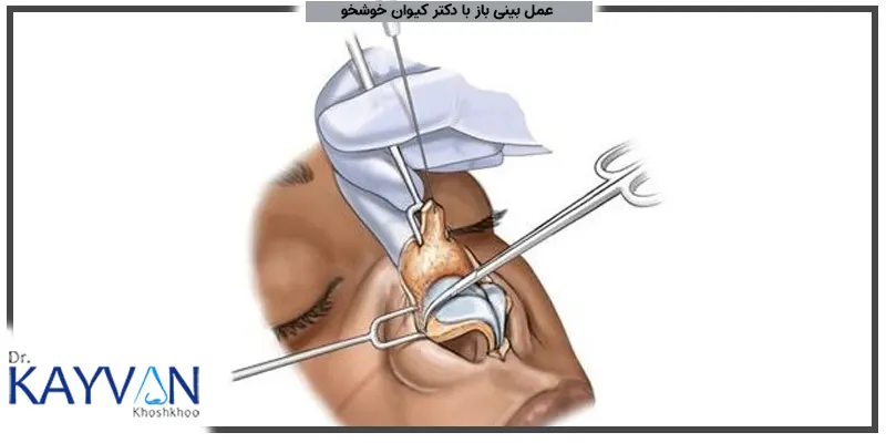 عمل-بینی-باز-با-دکتر-کیوان-خوشخو