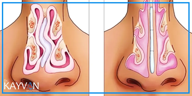 چگونگی-انجام-جراحی-انحراف-بینی
