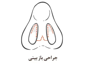 عمل بینی باز