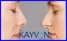 عوارض-جراحی-بینی-در-سنین-بالا