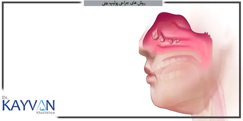 روش-های-جراحی-پولیپ-بینی