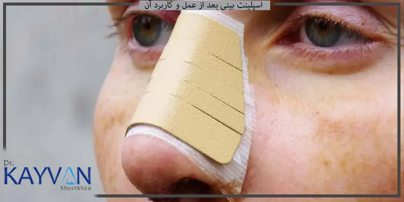 اسپلینت-بینی-بعد-از-عمل-و-کاربرد-آن