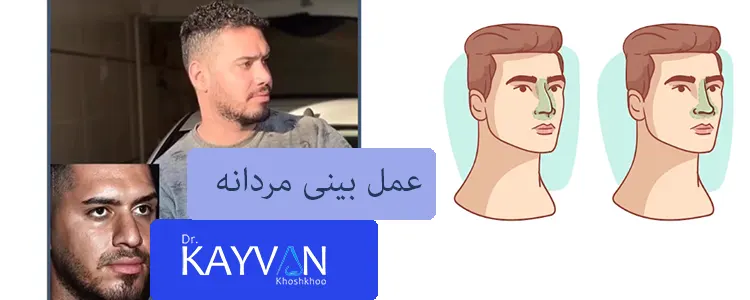 جراحی بینی مردانه