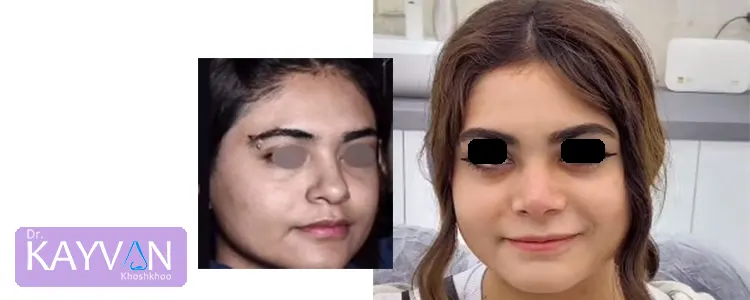نمونه کار جراحی بینی طبیعی