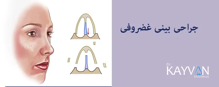 جراحی بینی غضروفی
