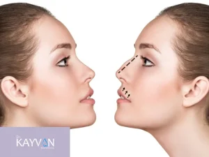 جراحی بینی های غضروفی